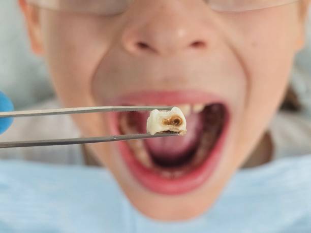 Best Emergency Root Canal Treatment in Rome City, IN